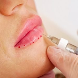 Will Lip fillers hide a gummy smile?
