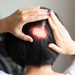 What is the best treatment for alopecia areata?