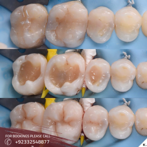 Dental Filling in Islamabad