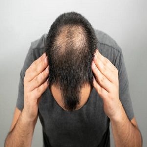 Special Considerations for Hair Transplants Across Age Groups