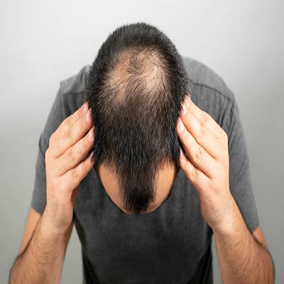 Special Considerations for Hair Transplants Across Age Groups | hair transplant