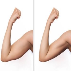 How do you get the best arm lift surgery results?