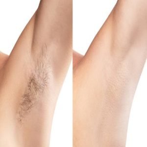 How do you remove hair from laser treatment?
