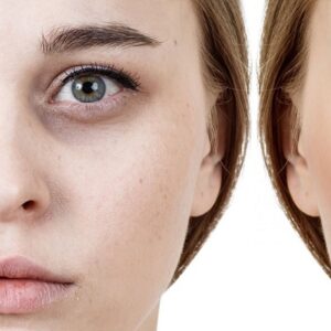 Dark Circles treatment pros & cons