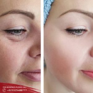 Eyelid Surgery – Blepharoplasty in Islamabad & Rawalpindi