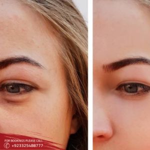 Eyelid Surgery – Blepharoplasty in Islamabad