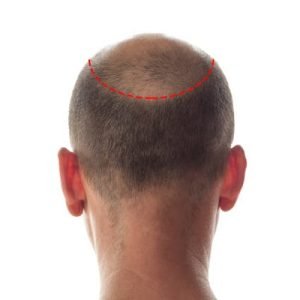 Important Facts About Hair Transplant