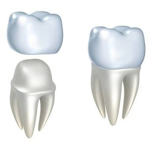 How long can a temporary dental crown last?