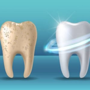 Impacts of teeth whitening on our personality