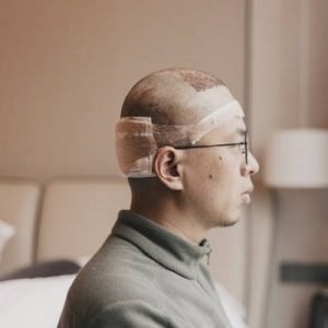 Robotic transplant better than a FUE hair transplant?