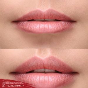 Lip Reduction in Islamabad