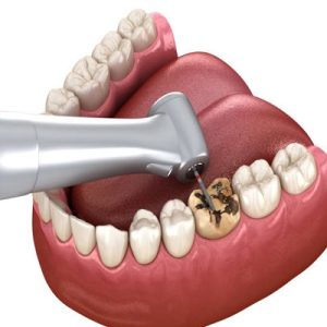 Gum Depigmentation Pros & Cons