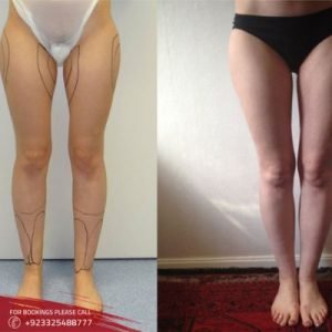 Thigh Lift in Islamabad