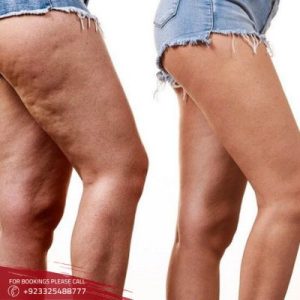 Thigh Lift in Islamabad & Rawalpindi