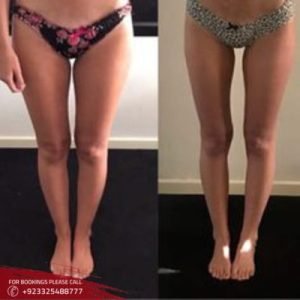 Thigh Lift in Rawalpindi