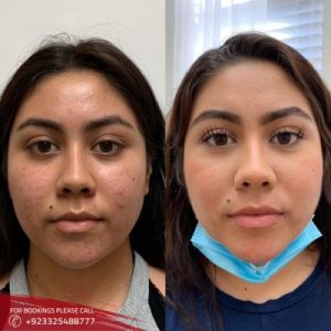 Filler Injections with PRP in Islamabad