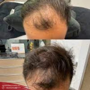 Exosomes hair therapy cost in Islamabad