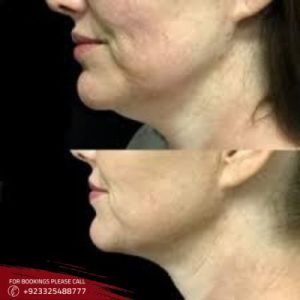 belkyra treatment before and after