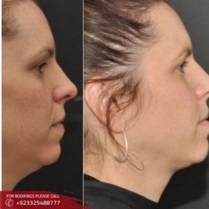 belkyra treatment cost in Islamabad