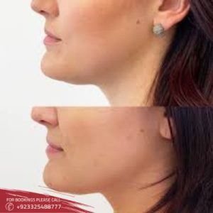 Results of Belkyra treatment