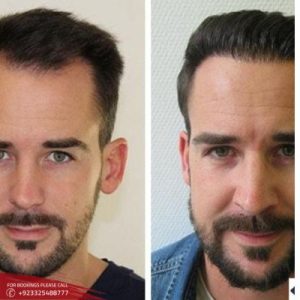 Front Line Hair Fixing before after