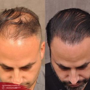 Front Line Hair Fixing cost in Islamabad