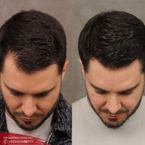 Results of Front Line Hair Fixing