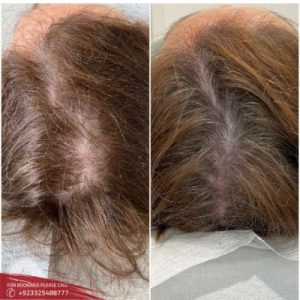 Results of Hair Fillers for Baldness