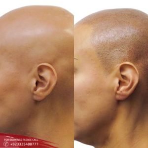 Scalp Micropigmentation in Islamabad and Rawalpindi