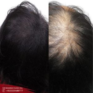 Scalp Micropigmentation in Islamabad and Rawalpindi
