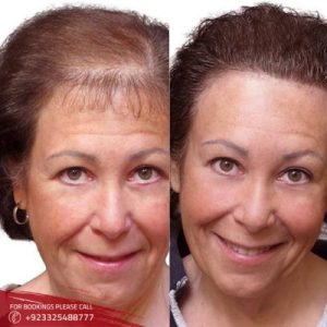 Results of Scalp Micropigmentation