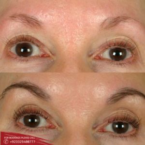Eyebrow Hair Transplant in Islamabad & Rawalpindi