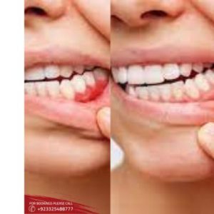Gum Bleeding Treatment in Islamabad, Rawalpindi