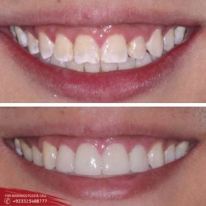 Gum Recession in Islamabad, Rawalpindi & Pakistan