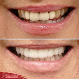 Gum Recession in Islamabad, Rawalpindi