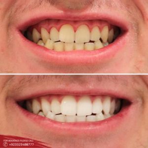 Gum Recession in Islamabad