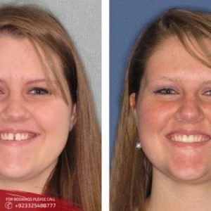 Gummy Smile Treatment before after