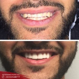 Hollywood Smile Design treatment before after