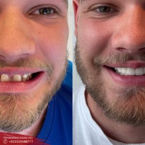 Hollywood Smile Design treatment cost in Islamabad