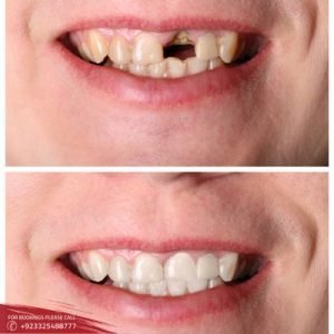 Teeth Fracture Treatment before after