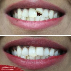 Teeth Fracture Treatment cost in Islamabad