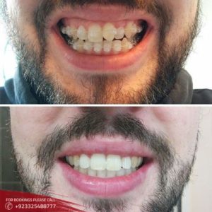 Dental Braces - Teeth Braces in Islamabad & Pakistan