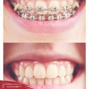 Dental Braces - Teeth Braces in Islamabad, Rawalpindi