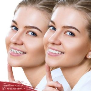 Dental Braces - Teeth Braces in Islamabad