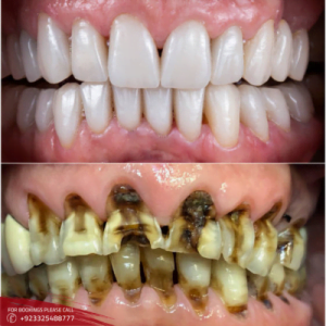 Results of Teeth Fracture Treatment