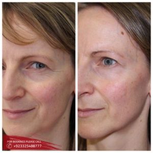 8 Point Facelift with Juvederm in Islamabad