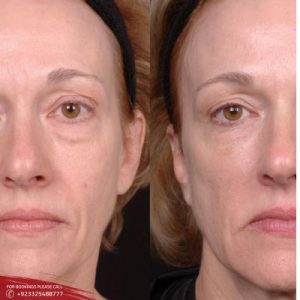 8 Point Facelift with Juvederm in Islamabad pakistan