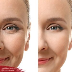 8 Point Facelift with Juvederm in Pakistan