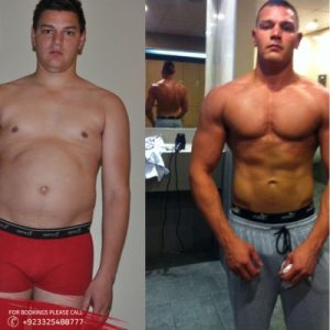 Macrolane Injections before after