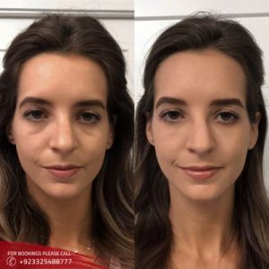 Macrolane Injections cost in Islamabad